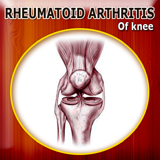 Rheumatoid Arthritis of Knee