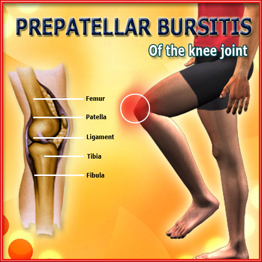 Prepatellar Bursitis