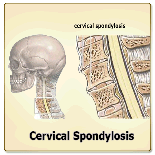 Cervical Spondylosis with Animations