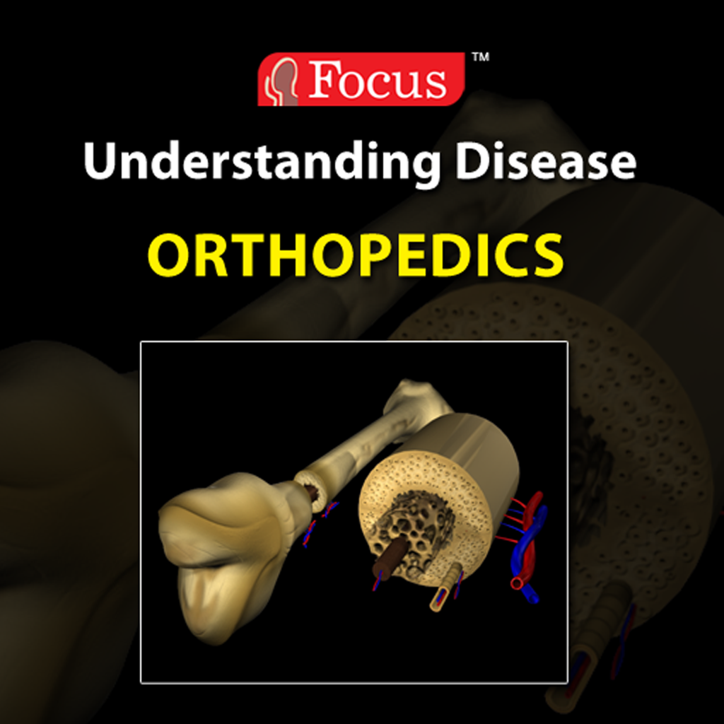 Orthopedics (Understanding Disease series)